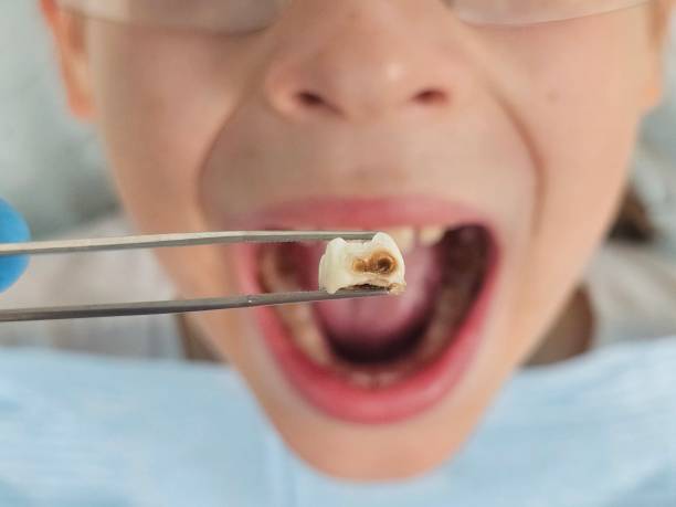 Best Emergency Dental Care for Broken or Chipped Teeth in Los Fresnos, TX